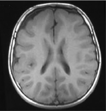 Figure-2-Agyria-and-pachygyria-T1-weighed-axial-section-on-MRI