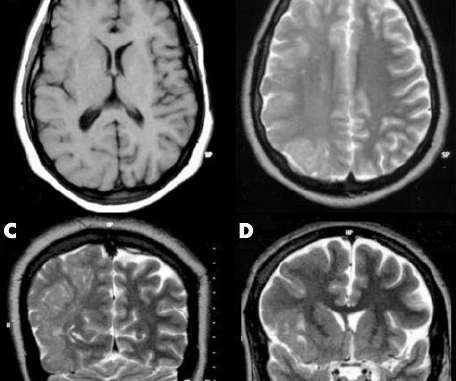 Figure-2-MRI-of-the-brain-showing-right-sided-hemimegalencephaly-and-pachygyria-A-T1