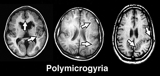 Figure-7-Human-symmetric-polymicrogyriaAxial-transverse-MRI-scans-of-patients-with.png